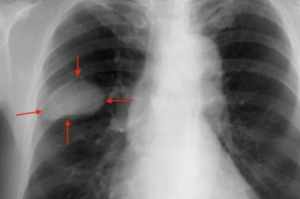 Cáncer de pulmón en Argentina | La importancia de la detección temprana y los desafíos para ampliar el acceso al tamizaje